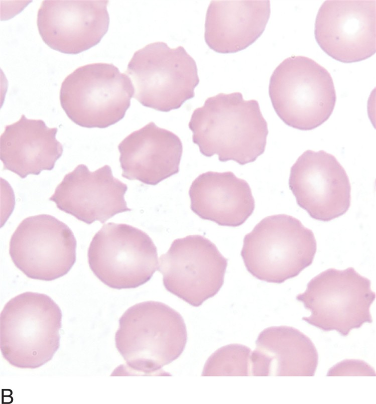 <p>what is an echinocyte (burr cell)?</p>