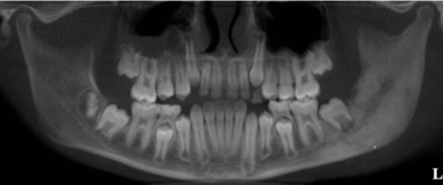 <p>What is the differential diagnosis of the left angle-ramus of mandible?</p>