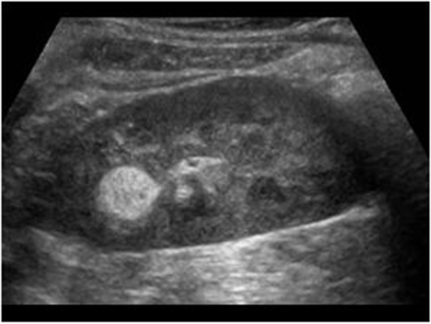 <p>Sonographically, lipomas appear well-defined and ___ </p>