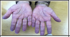 <p>\n A bluish-purple discoloration of the skin and nails.</p>