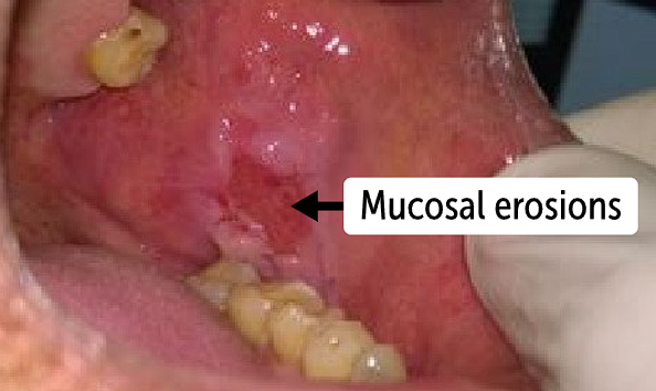 <p><strong>flaccid blisters with an erythematous base</strong></p><ul><li><p>When blisters rupture, they cause <strong>painful, bleeding lesions</strong></p></li></ul><p></p>