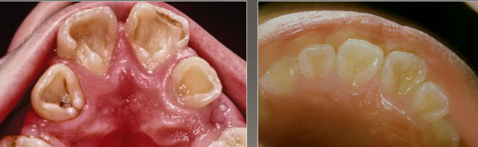 <ul><li><p>Prominent marginal ridges on maxillary incisors (esp centrals)</p></li><li><p>Associated with dens evaginatus</p></li><li><p>Usually bilateral</p></li><li><p>Most common in Asians</p></li></ul><p></p>