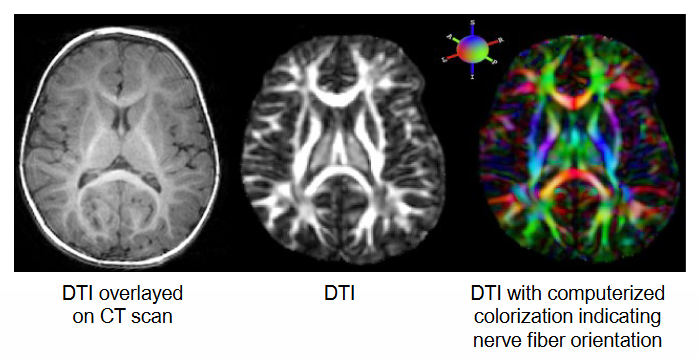 <p>= MRI method that detects the <span style="color: red">directional movements</span> of water molecules.</p><ul><li><p>Water can move relatively free along the axon but less freely across cell membranes.</p></li><li><p>Used to create virtual images of <span style="color: red">nerve fiber tracts</span> in the brain and identify changes in <span style="color: red">axon myelination</span> (e.g. myelin loss in MS).</p></li></ul><p>Tells you the structure inside the brain??</p>