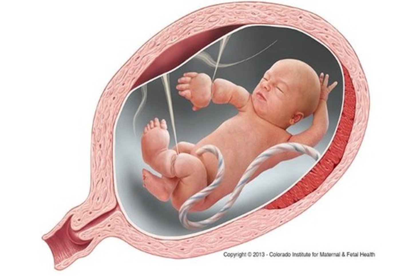 <p>Amniotic band syndrome</p>
