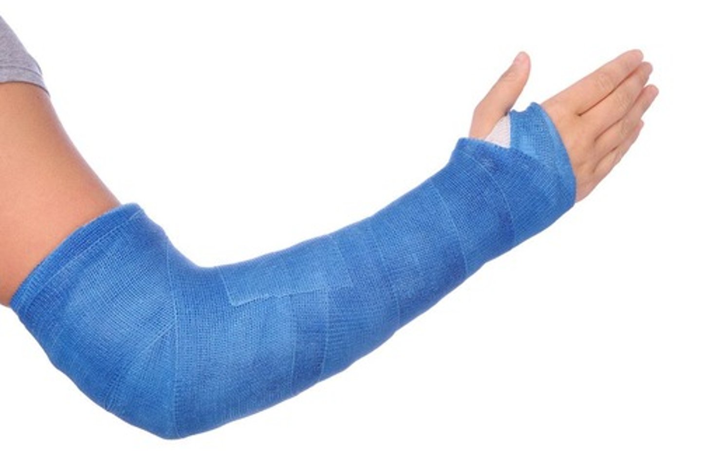 <p>external brace to support bone remodeling, usually only for children or minor adult fractures</p>