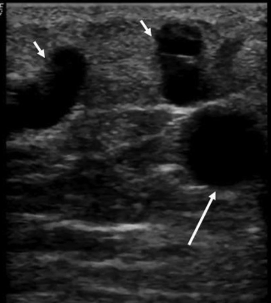 <p>Dilated tortuous veins</p><p>Impact ability to use vessel as bypass</p>