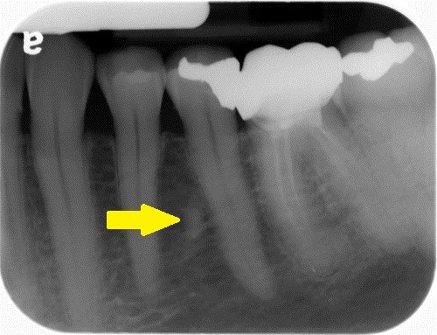 <p>Radiolucent line; between tooth and cortical bone (lamina dura)</p>