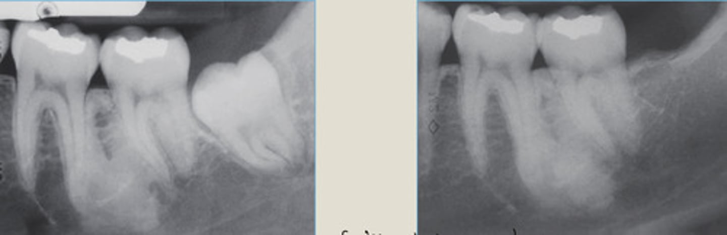 <p>Large area of radiopacity fusing with lamina dura</p><p>NO TX</p>