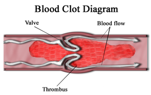 <p>Thrombus</p>