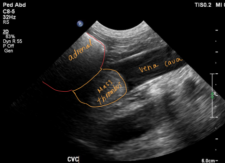 <p><span style="background-color: transparent;"><strong>Pheochromocytoma</strong></span></p>