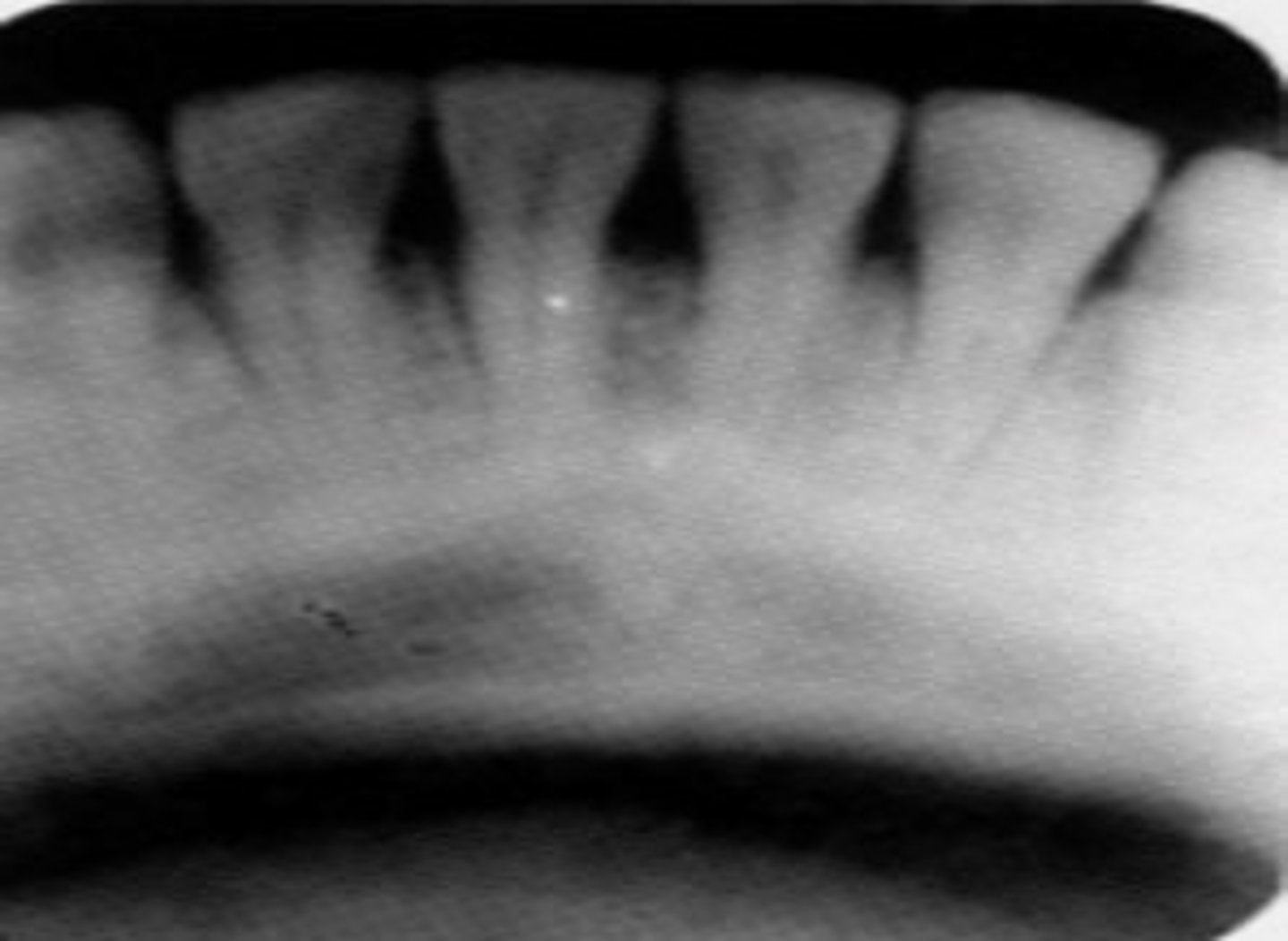 <p>Excessive vertical angulation.</p>