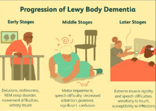 <ul><li><p>Can be misdiagnosed as PD</p><ul><li><p>Sleep</p></li><li><p>Behavior changes</p></li></ul></li></ul><p></p>