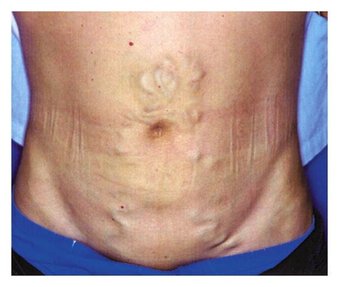 <p>Varicose enlargement of periumbilical veins due to portal HTN sometimes seen in patients w/ liver cirrhosis</p>