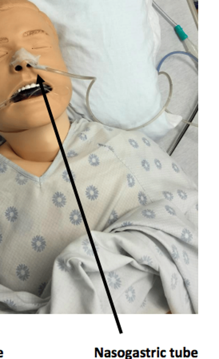 <p>feeding tube inserted in nose that goes down into pt.'s stomach</p><p>- can remove fluid, gas, content from stomach through this tube, can also administer medication</p><p>- pt. cannot have anything by mouth</p><p>- short term</p><p>- pt. should not flex head or bend forward</p>
