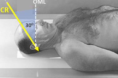 <ul><li><p>30 caud</p></li><li><p>2.5”&nbsp; above the glabella passing thru the EAM</p></li><li><p>vertex → occiput (?)</p></li><li><p>suspend</p></li><li><p>122cm</p></li><li><p>AP, OML perp to IR, skull vertex at the top collimation border</p></li></ul><p></p>