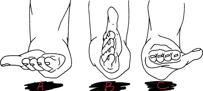 <p>Which one is in the supinated position?</p>