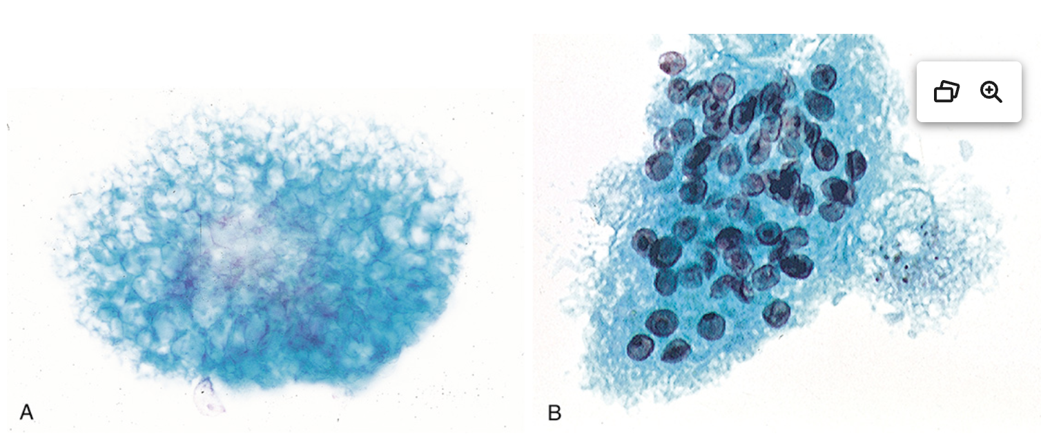 <p>Lavage broncho-avléolaire </p><p>1) Diagnostic</p><p>2) Contexte</p><p>3) Colorations </p>