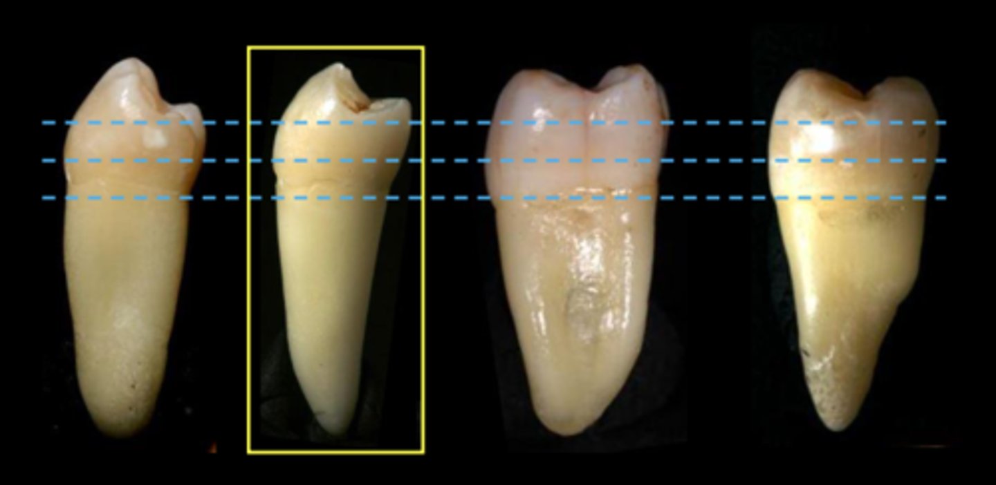 <p>Lingual HOC for mandibular 2nd premolar</p>