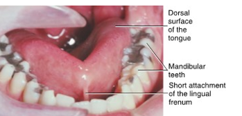 <ul><li><p>short lingual frenum attachment that extends to tongue’s apex</p></li><li><p>restricts movement of the tongue to varying degrees</p></li></ul><p></p>