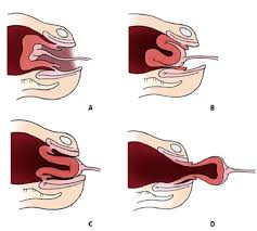 <p>turning inside out of the uteurs and can be partial or complete, emergecy sitauion</p>