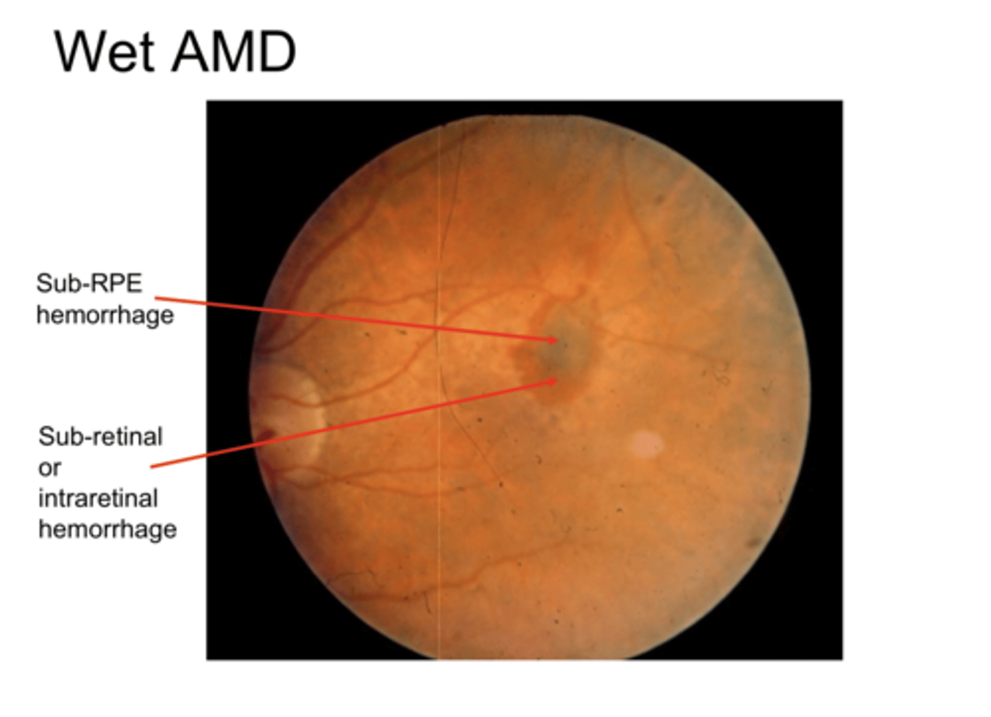 <p>Wet AMD (Pic)</p>