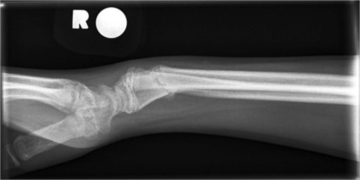 <p>smith → fragment moves towards the PALM</p><p>know imaging!!!</p>