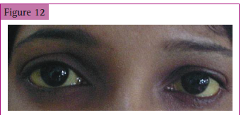<p>Yellowish discoloration of sclera in a patient with</p>