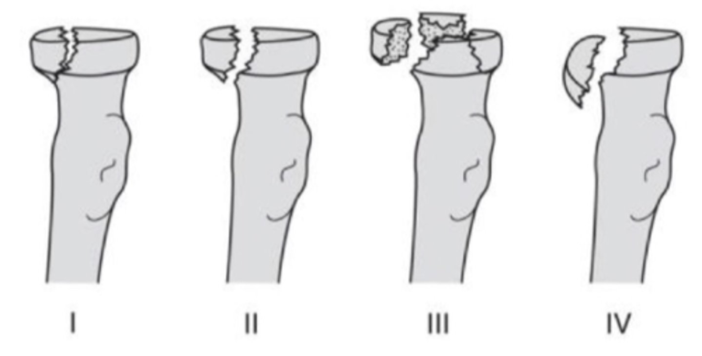 <p>4 types<br>- type 1: undisplaced<br>- type 2: marginal fx w displacement<br>- type 3: comminuted fx<br>- type 4: radial head fx and dislocation</p>