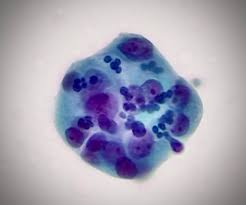 <p>femme post ménopausique, frottis cervical</p><p>1) Diagnostic</p><p>2) Cytomorphologie </p><ul><li><p>Architecture</p></li><li><p>Noyaux </p></li><li><p>Autres </p></li></ul><p></p>