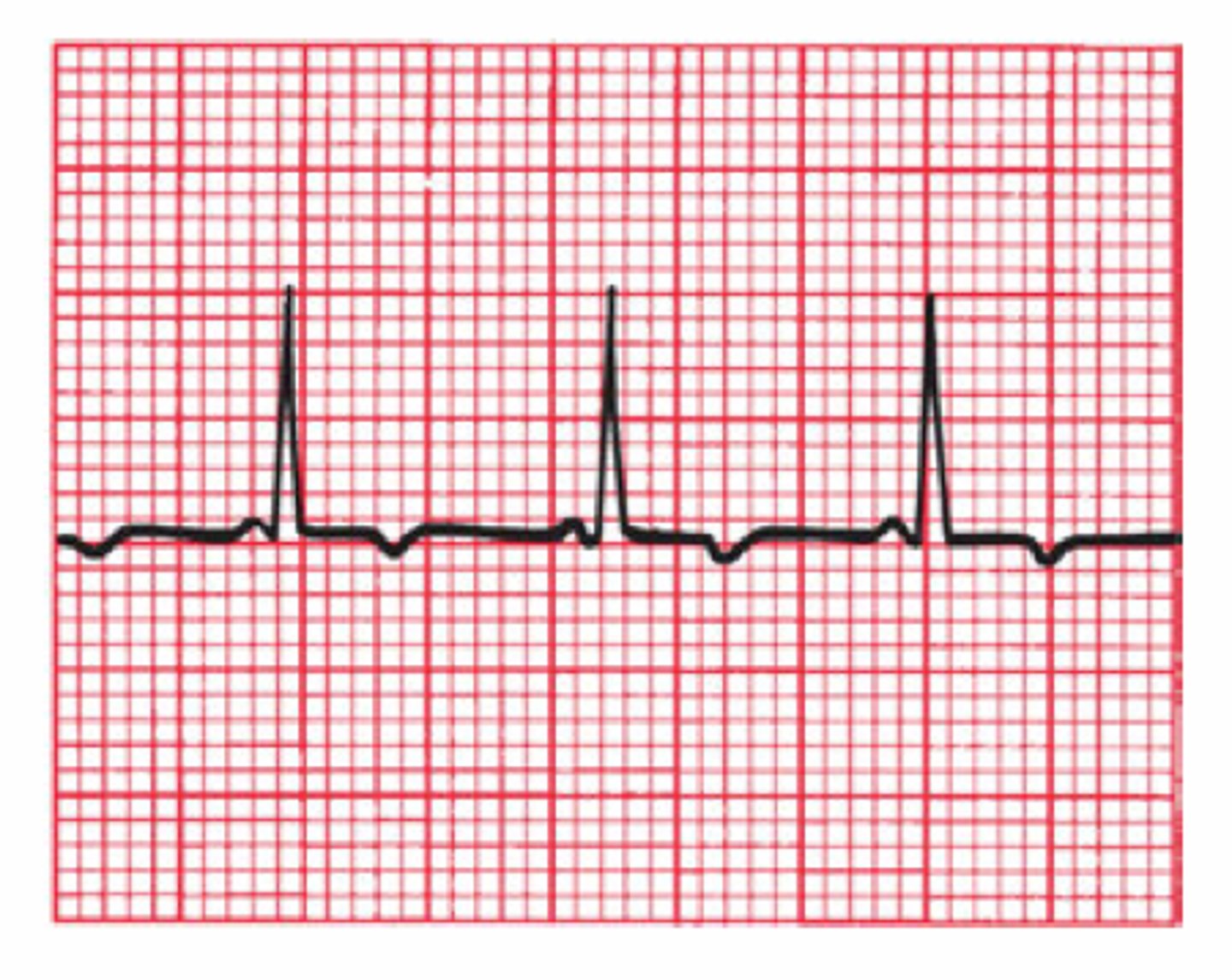 <p>Which Arrythmia is this?</p>