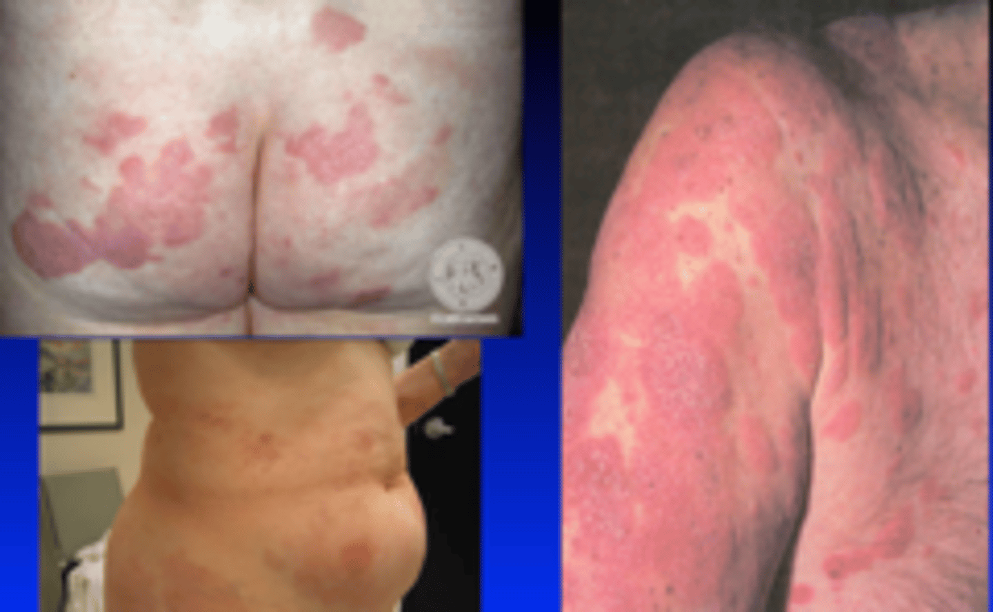 <p>diagnose this:</p><p>Randomly distributed, scaling &amp; non- scaling erythematous plaques (Plaques start thin, then become thicker over the years)</p>
