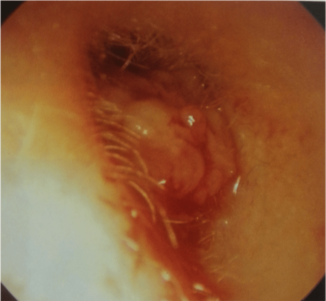 <p>considered a tumor<br>symptoms:<br>-Ear drainage (otorrhea)<br>-Ear pain (otalgia)<br>-Hearing loss<br>-Facial nerve paralysis</p>