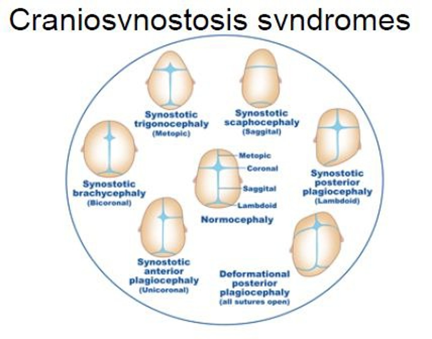 <p>premature closure of cranial sutures →results in compensatory skull growth perpendicular to affected suture → inc. brain pressure → learning/developmental/vision, behavioral/self-esteem probs</p>