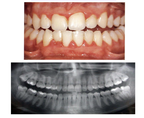 <p>inflammation only, no attachment loss, no bone loss</p>