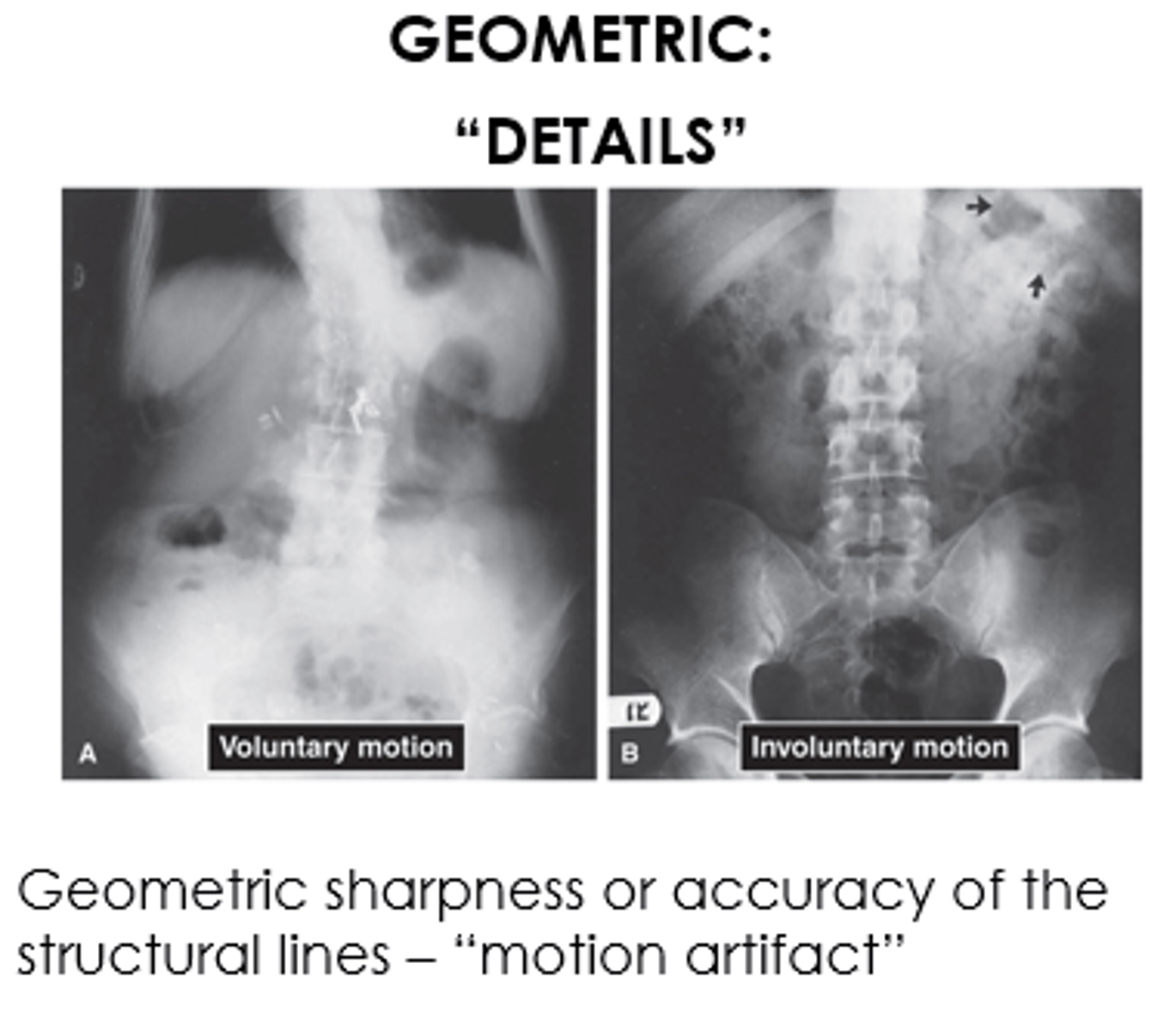 <p>- Geometric sharpness or accuracy of the structural lines recorded on the radiograph</p><p>- Usually because of motion artifact</p>