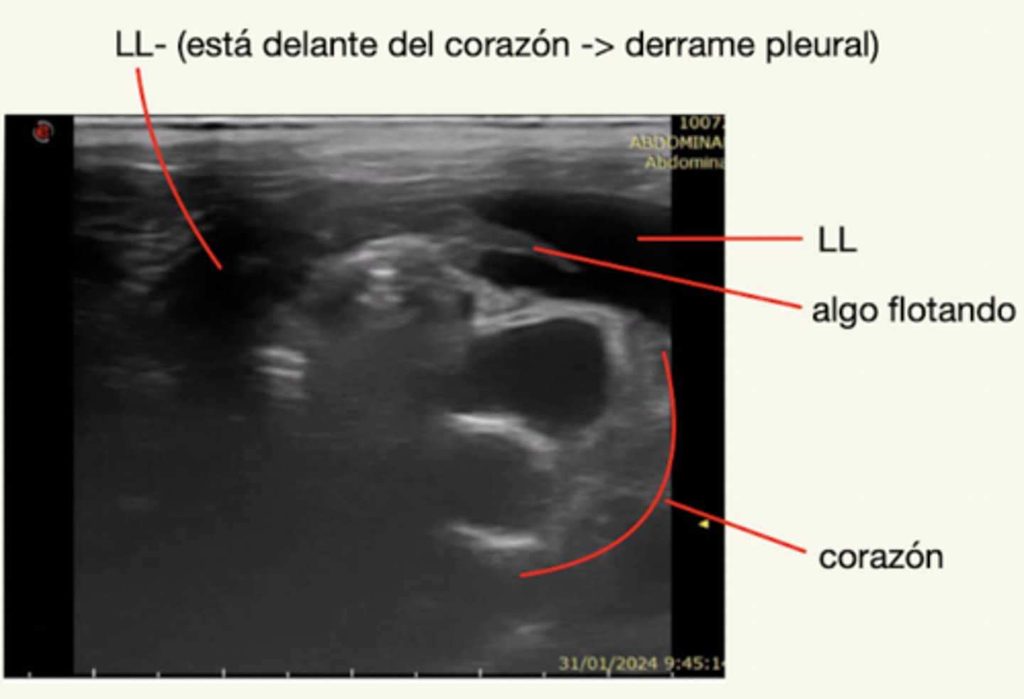 <p>derrame pleural</p>
