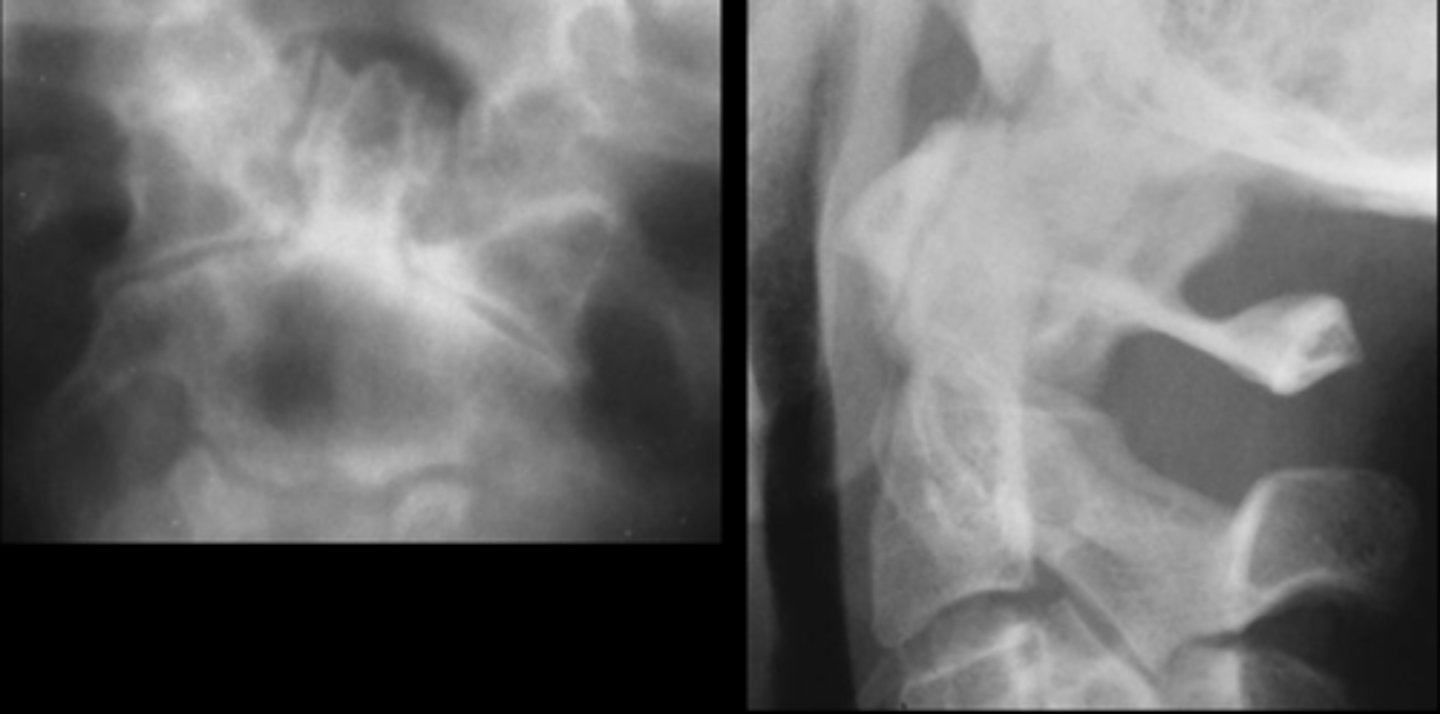 <p>ID type of degenerative spine disease</p>