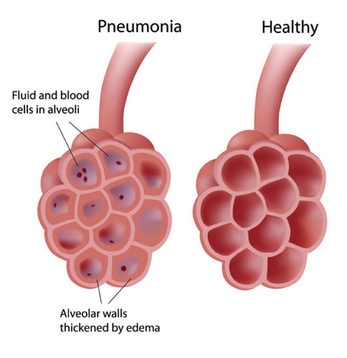 <p>- Pneumonia is an infection of the lungs caused by bacteria, viruses, fungi or other organisms.</p><p>- The inflammation caused by the infection causes secretion of fluid and mucus into the alveoli, decreasing the amount of air they can contain.</p><p>- Surface area for gas exchange is also reduced.</p><p>- Tuberculosis is an infection of the lungs by the bacterium, 'Mycobacterium tuberculosis.'</p><p>- It spreads through droplets by sneezing, coughing or spitting. So any droplets of moisture containing the virus can be inhaled by others.</p>