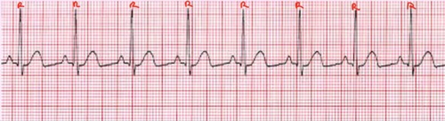 <p>What is the heart rate of this ECG strip?</p>