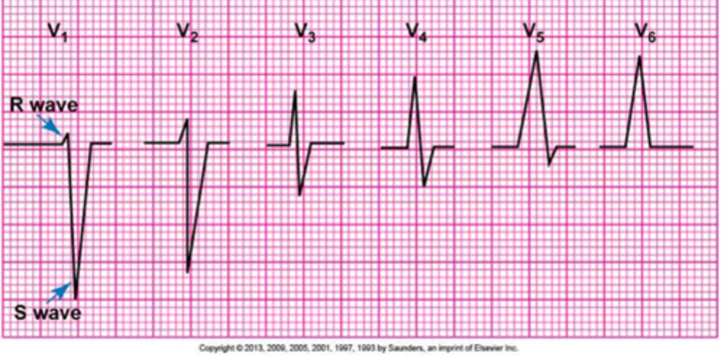<p>Positive</p><p>(Think about r-wave progression)</p>