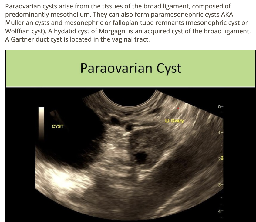 <p>d) morgagni or mesonephric cyst</p>