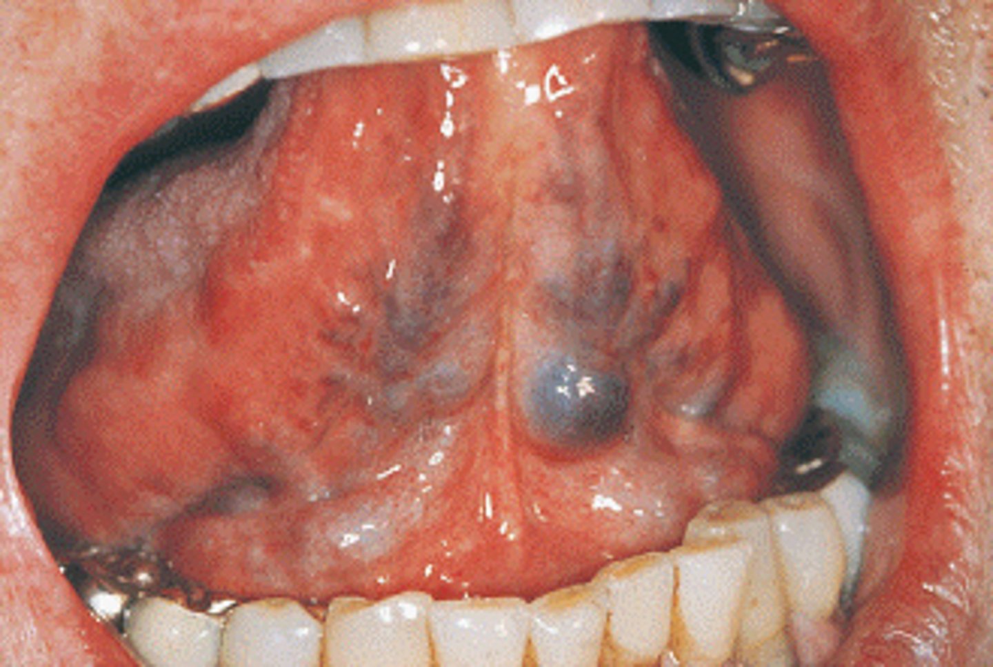 <p>These reddish-purple clusters observed on the ventral surface of the tongue and diagnosed through clinical observation are referred to as which variants of normal conditions?</p><p>A.Palatal cyst</p><p>B.Mandibular tori</p><p>C.Lingual varicosities</p><p>D.Ranula</p>