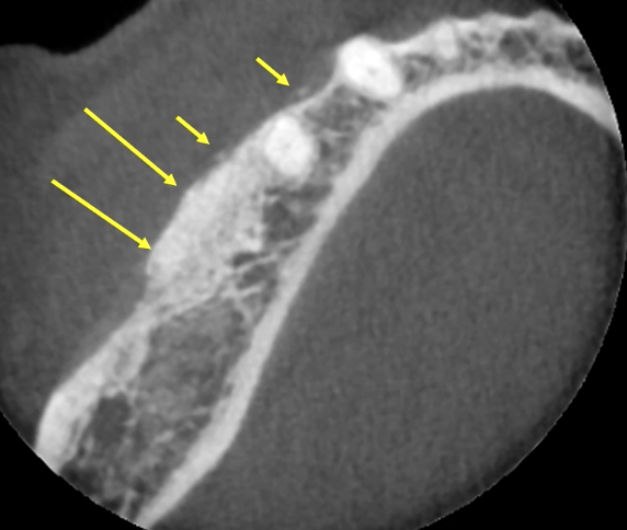<p>granular appearrance in edentulous sites with loose fragments of bone within soft tissue</p>