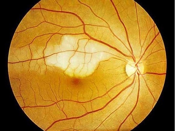 <p>What is the patient likely experiencing?</p><p></p><p>Sudden, painless, monocular loss of vision</p><p>The patient has hypertension and a history of stroke</p><p>Affected eye has lost all light perception except in the inferior periphery, where the patient can detect hand movements</p><p>Affected eye demonstrates a slight RAPD</p>