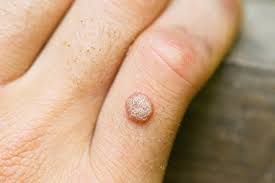 <p>the wart</p>