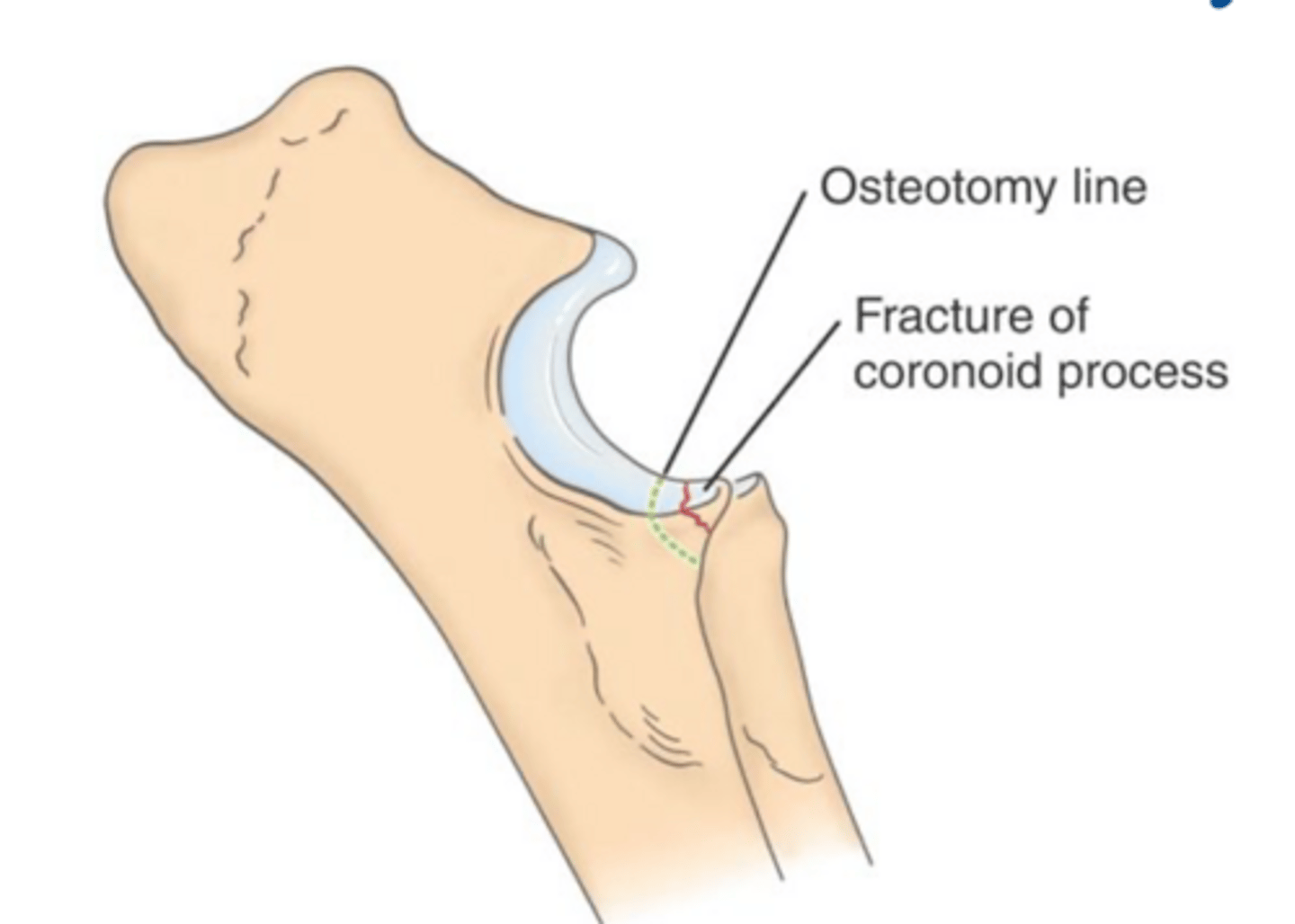 <p>if arthroscopy or arthrotomy fails to demonstrate a fragment in FCP sx. a _____ can be performed if suspicious of incomplete fragment of coronoid</p>