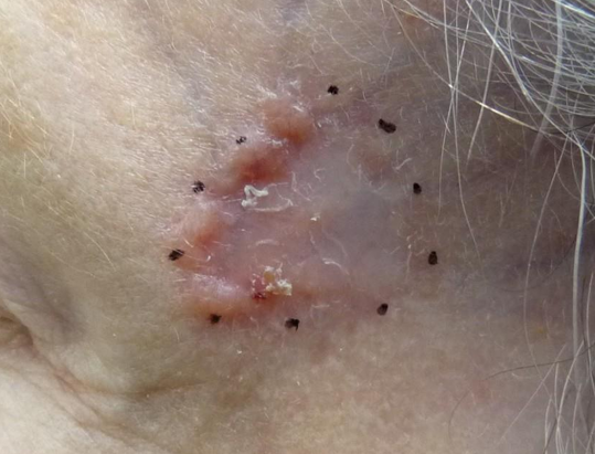 <p>Hoe heet dit klinisch beeld (tip: atrofie)</p>