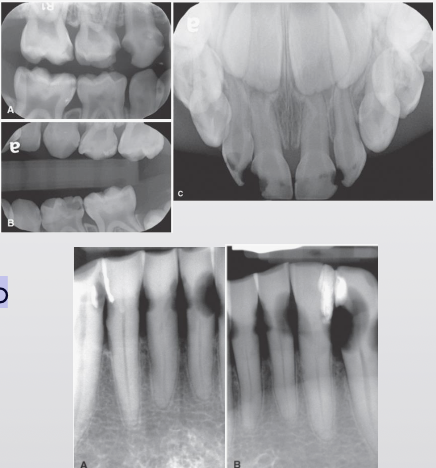 <p>What are rampant caries?</p>