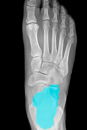 largest tarsal bone
articulates w talus and cuboid bone