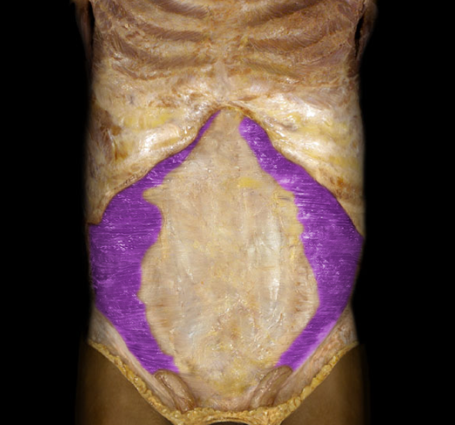 <ul><li><p>Action: Compression of anterior abdominal wall and viscera (increases intra-abdominal pressure)</p></li><li><p>Origin: Ilium (crest), Inguinal ligament, Thoracolumbar fascia, Costal cartilages 7-12</p></li><li><p>Insertion: Pubis (body), Linea alba, Sternum (xiphoid process)</p></li><li><p>Innervation: Ventral rami of T8-L1 spinal nerves</p></li></ul><p></p>